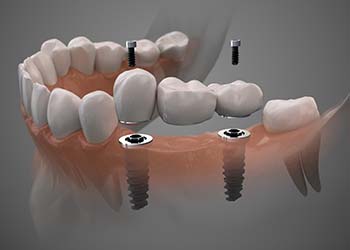 two dental implants securing a dental bridge