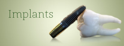 Dental Implants