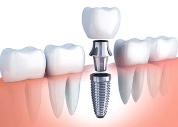 single dental implant with abutment and crown being placed in the jaw