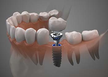 single dental implant with a crown