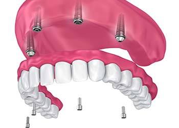 four dental implants supporting a full denture