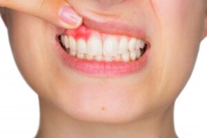 Closeup of patient exposing their gums to reveal gum disease