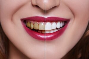 Closeup of a smile split down the middle before and after teeth whitening